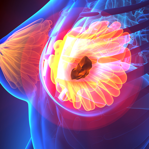 Cancro mammario: uso della radiomica per prevedere la risposta alla chemioterapia