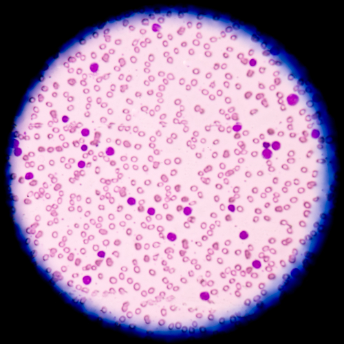 Leucemia linfoblastica acuta: nuovo strumento per predire ricadute