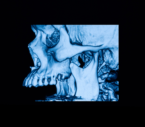 Sopravvivenza degli impianti posizionati nella tuberosità pterigoidea e mascellare