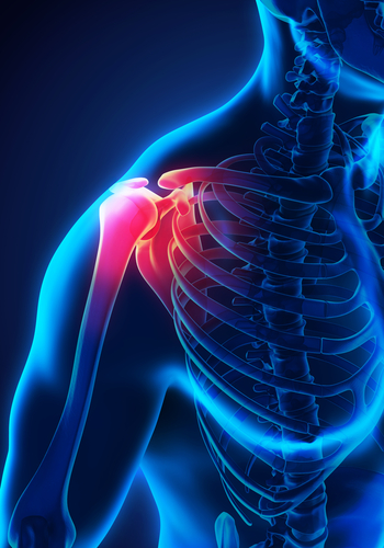 Intervento ecoguidato per la spalla congelata nella fase di congelamento