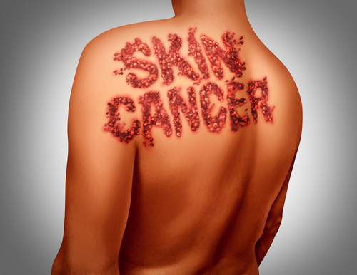 Tumori cutanei non melanomatosi: marcatore genetico incrementa il rischio