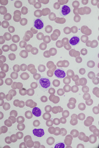 Uso di selenio come terapia complementare nella leucemia e in altri tumori