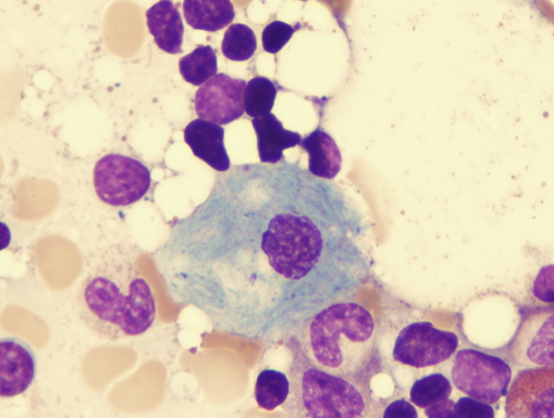 Malattia di Gaucher neuronopatica sarebbe associata a ridotta vascolarizzazione cerebrale