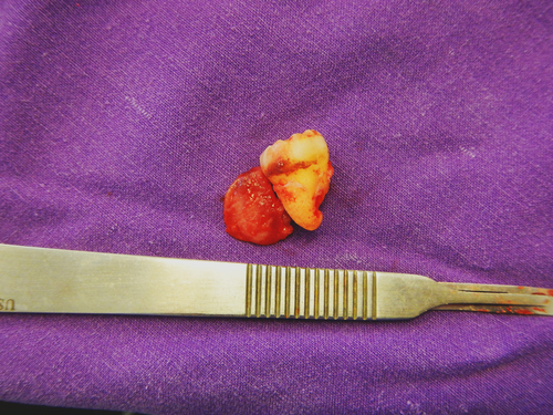 Cisti gengivali dell’adulto, cisti parodontali laterali e cisti botrioidi odontogene