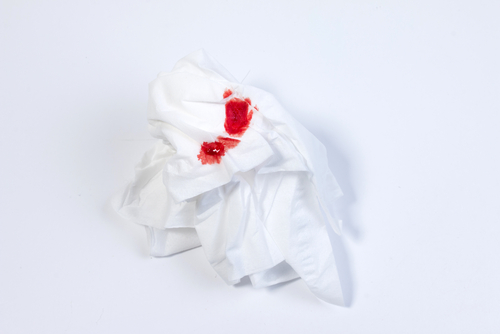 Epistassi dell’adulto: gestione e fattori ematologici