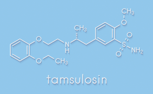 Grandi calcoli ureterali distali: tamsulosina aiuta nell’espulsione