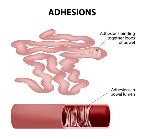Ostruzioni del tenue da aderenze: ritardi nella chirurgia per i pazienti di razza nera