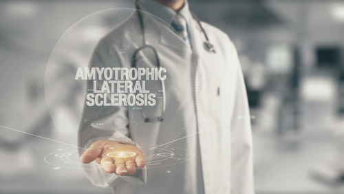 Sclerosi laterale amiotrofica: necessità di una diagnosi precoce