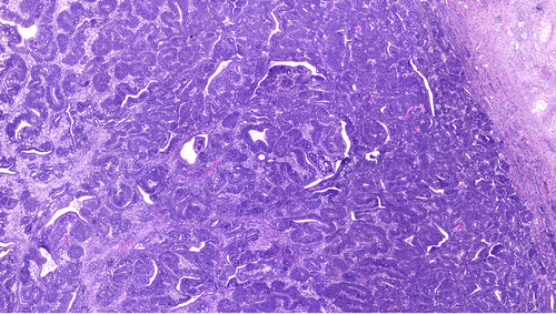 Tumore di Wilms: ulteriore definizione degli indicatori prognostici