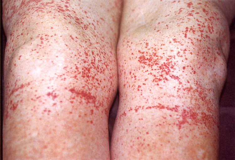 Piastrinopenia immune: studio conferma controllo di malattia a lungo termine con eltrombopag