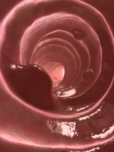 Impiego del CADx nella diagnosi ottica dei piccoli polipi rettosigmoidei