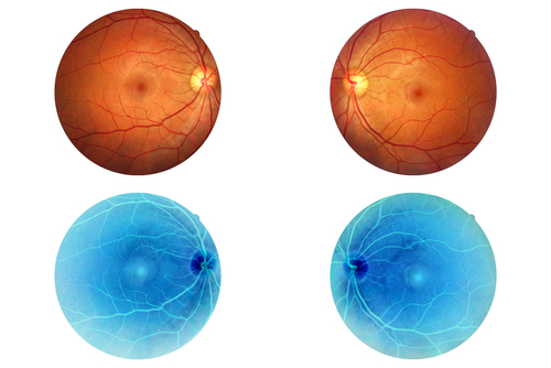 Modifiche a livello oculare indotte dalla MPS VI nei pazienti pediatrici