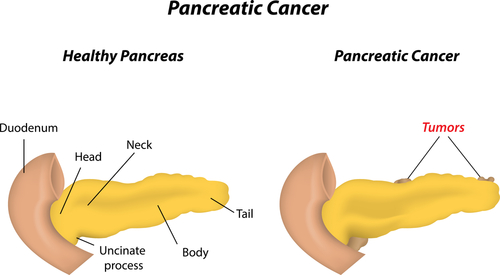 Adenocarcinoma pancreas: alterazioni geni associati a specifiche metastasi 