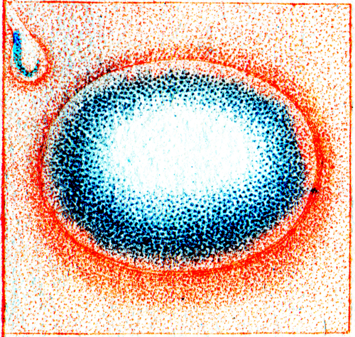 Pemfigoide bolloso e sue comorbidità