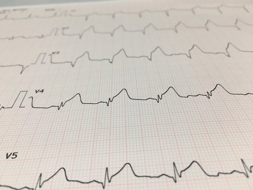 Emorragia intramiocardiaca determina una prognosi peggiore dopo un infarto