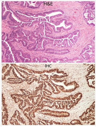 Una tecnica per identificare le varianti di MSH2 associate alla sindrome di Lynch