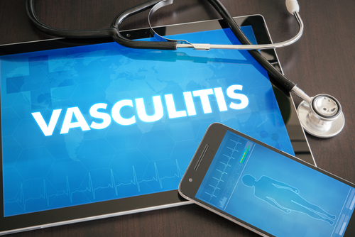 Vasculite crioglobulinemica associata all’Hcv si risolve con la cura virologica