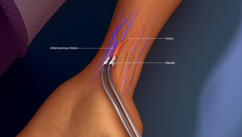 Dialisi: chiusura fistola dopo trapianto arresta rimodellamento cardiaco