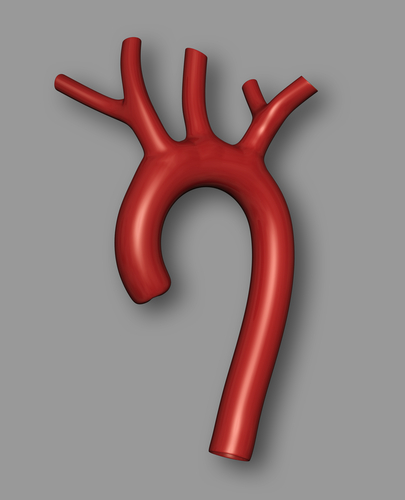 Diabete e dissezione aortica tipo A: nessun impatto sulla mortalità post-chirurgica
