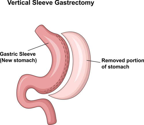 Gastrectomia migliora complicanze delle IBD associate ad obesità