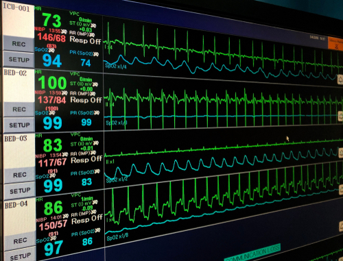 STEMI: non necessaria la terapia intensiva per alcuni pazienti