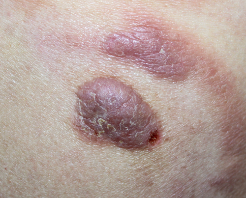 Micosi fungoide: idonei PUVA a basse dosi e frequenza per terapia di mantenimento