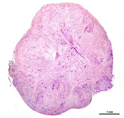 Schwannoma vestibolare: serve la RM 6 mesi dopo la radiochirurgia?
