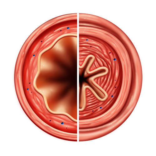 Mucopolisaccaridosi: come cambia la gestione delle vie respiratorie man mano che i pazienti invecchiano