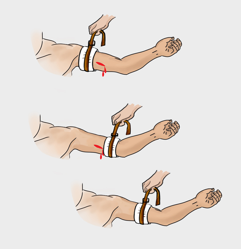 Lacci emostatici riutilizzabili per venopuntura spesso contaminati