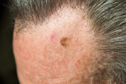 Lentigo maligna: stima del rischio di progressione verso il melanoma