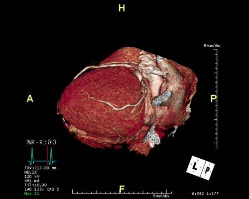 Quando è più appropriata la CTA coronarica per le sospette cardiopatie?