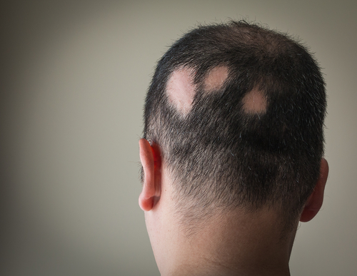 Alopecia areata: fattori traumatici e psicologici mostrano sempre più un peso nella malattia