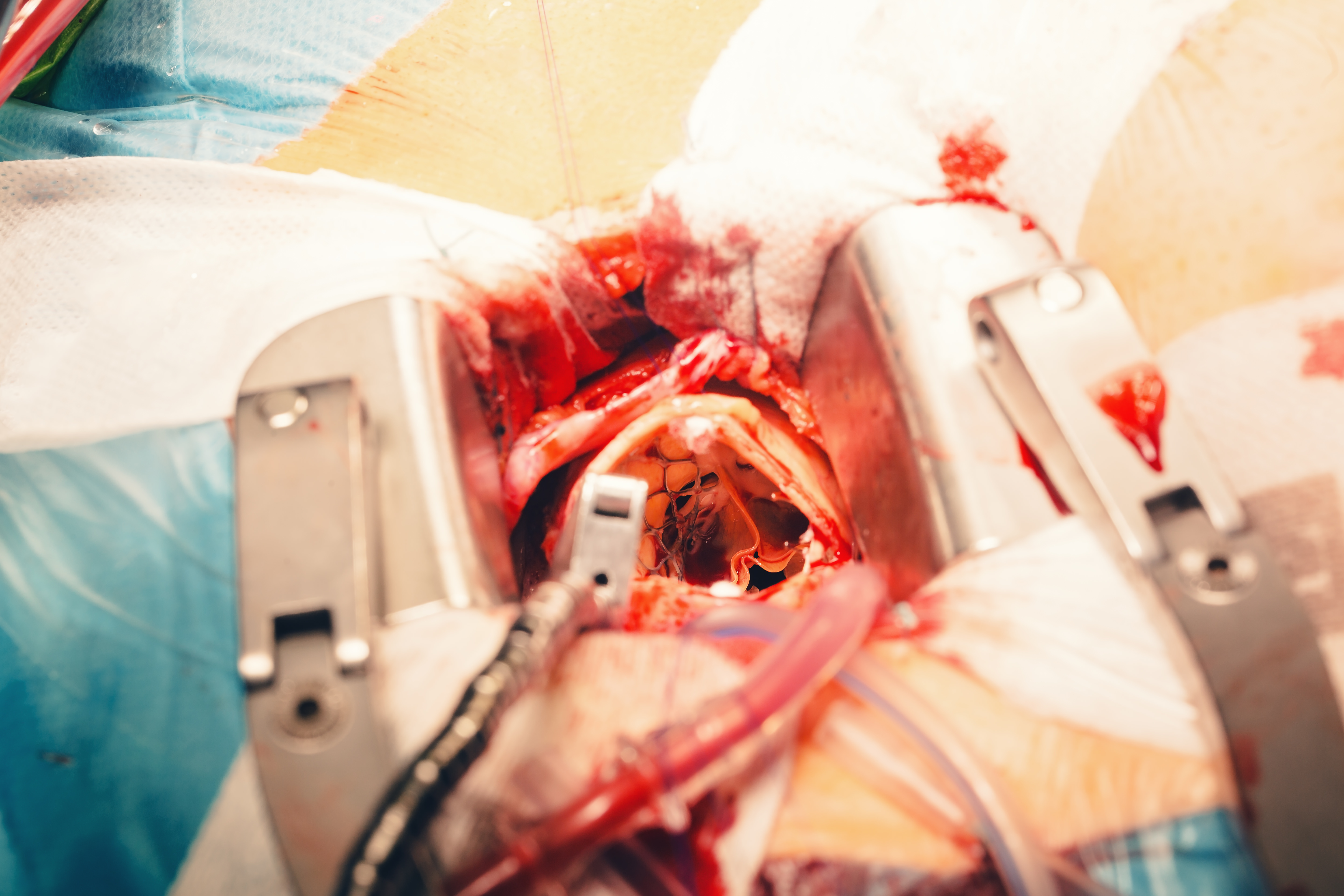 L’hostile score predice le complicanze vascolari non puntiformi dopo TAVR