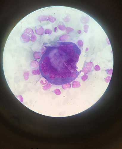 Leucemia megacarioblastica acuta: il ruolo dei geni