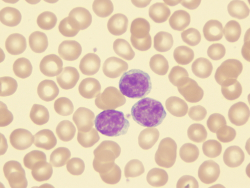Leucemia linfoide cronica: miglioramento della sopravvivenza nel’assistenza di routine