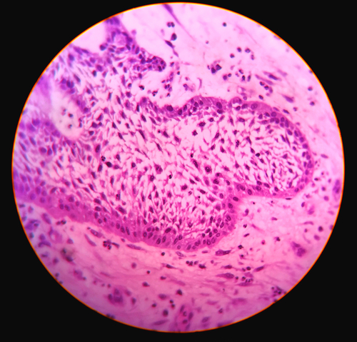 Ameloblastoma desmoplastico: una revisione della letteratura