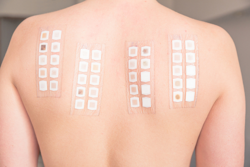 Dermatite da contatto: patch test identifica allergeni responsabili