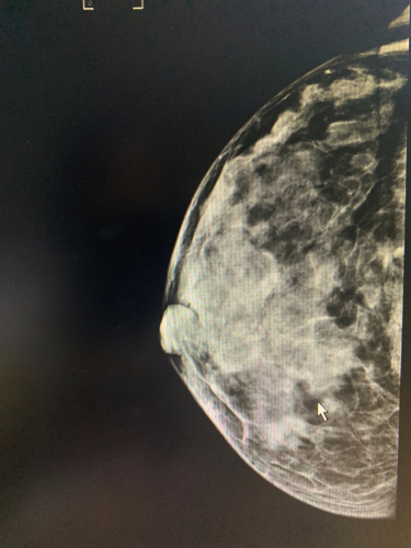 Screening cancro della mammella: raccomandazioni task force statunitense