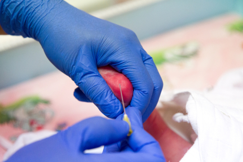 Malattie rare, efficace lo screening neonatale su campioni analizzati con microfluidica digitale