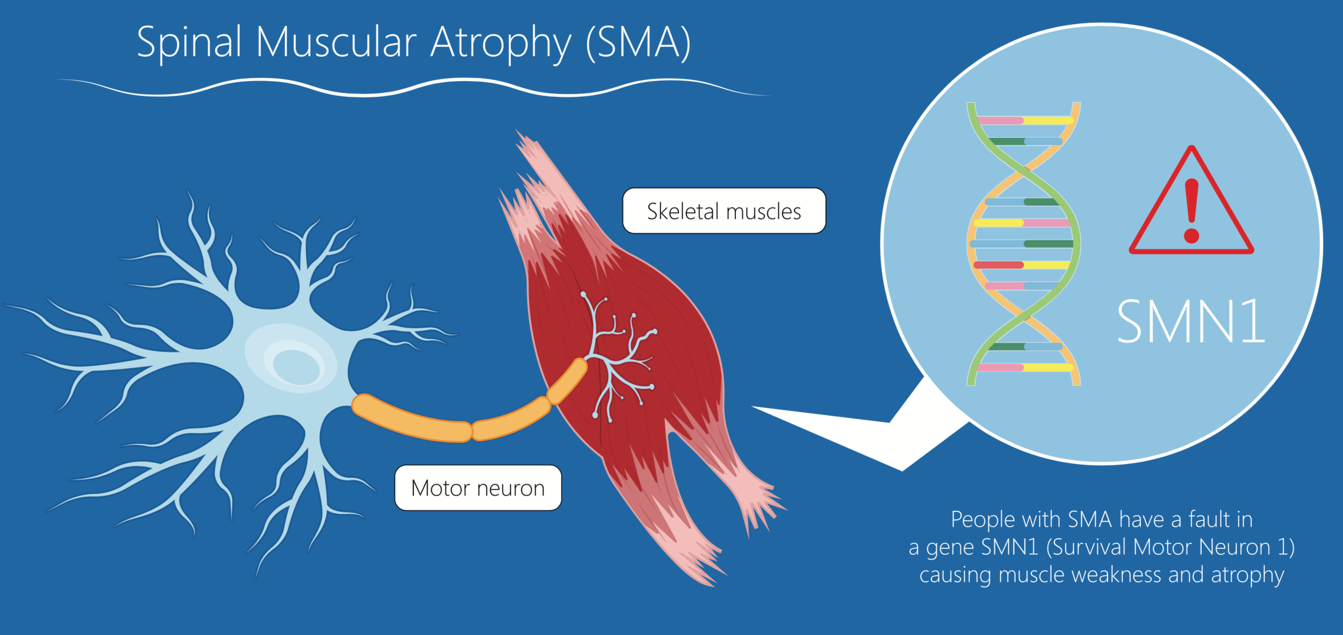 SMA pediatrica: nuovi dati dallo studio FIREFISH su risdiplam