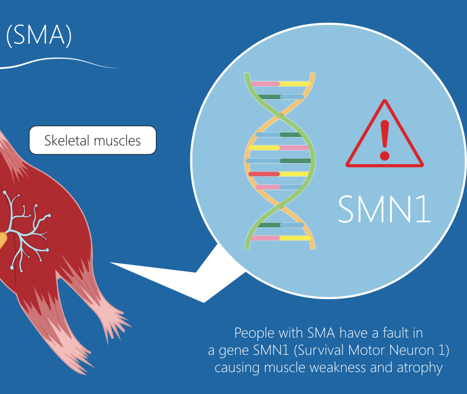 Al via “OneGene”, primo Programma di Supporto per i pazienti con SMA trattati con la Terapia Genica
