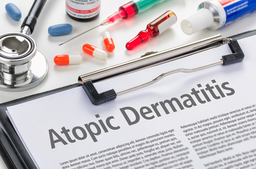 Dermatite atopica. Diagnosi: criteri e difficoltà