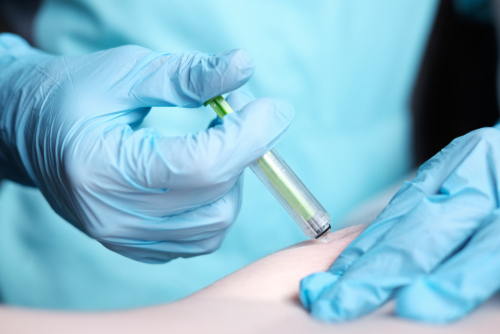 Chirurgia oncologica: dosi personalizzate di enoxaparina per prevenire le tromboembolie