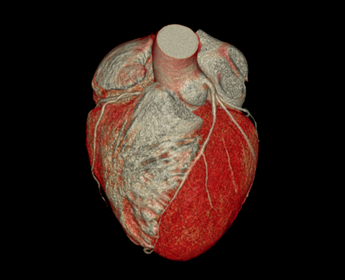NSTEMI: elevata accuratezza diagnostica della TC coronarica