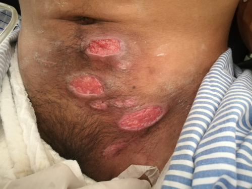 Idrosadenite suppurativa: epidemiologia, diagnosi, patogenesi e qualità della vita