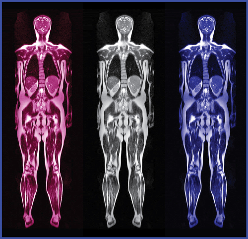 Malattia di Pompe: utilità clinica della risonanza magnetica whole-body