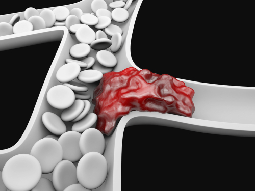 Mobilizzazione precoce non strumentale per diminuire l’incidenza della TVP in pazienti ospedalizzati