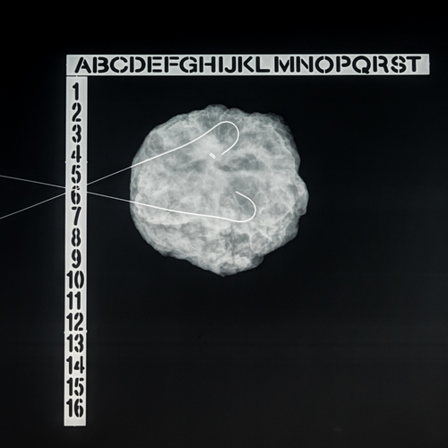 Iperplasia duttale atipica mammaria: un aggiornamento sulla gestione