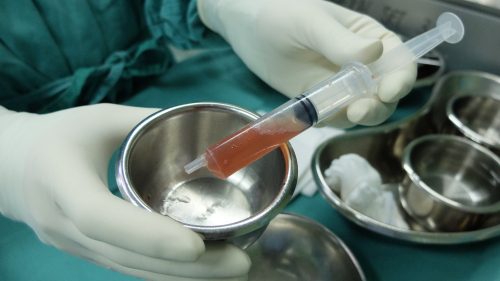 Tumori ovarici avanzati: diagnosi accurata con la citologia dell’ascite