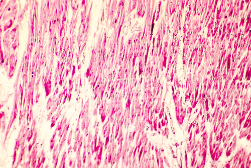 Cardiomiopatia ipertrofica ostruttiva: miectomia o ablazione settale alcolica?